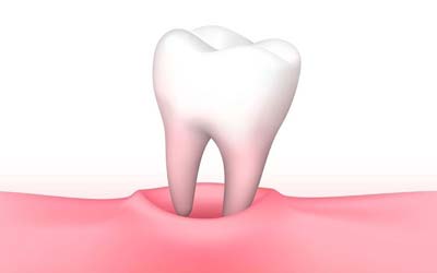 Extracted tooth